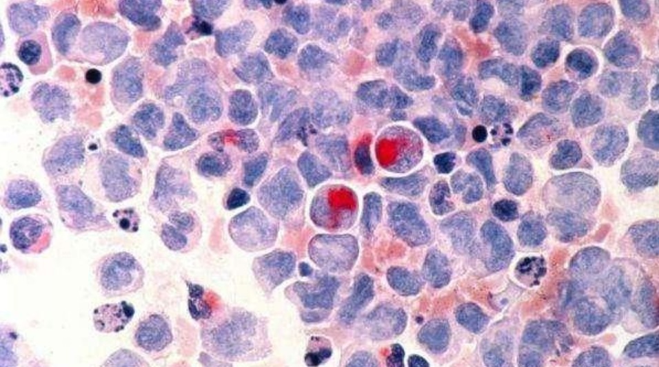 美国研发出癌症疫苗,实现100%治愈癌变细胞 美国研发出癌症疫苗,实现100%治愈癌变细胞