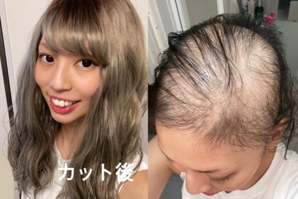 她7月中开始购买假发，右为21日掉发状况